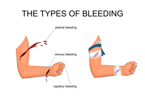 A Basic Guide to Wound Packing